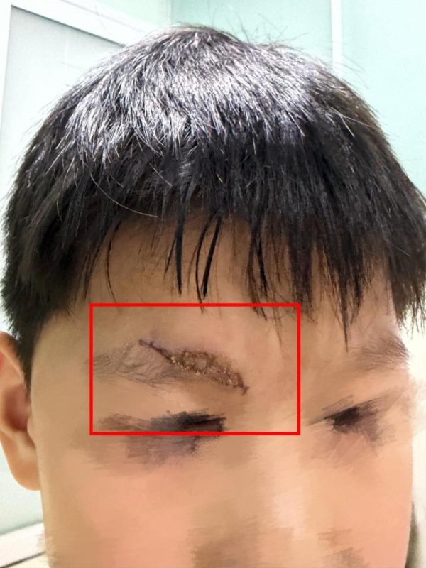 天平配资 男童游乐场摔伤 家长索祛疤费遭拒 安全隐患引争议