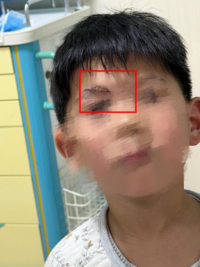 男童游乐场摔伤 家长索祛疤费遭拒 安全隐患引争议